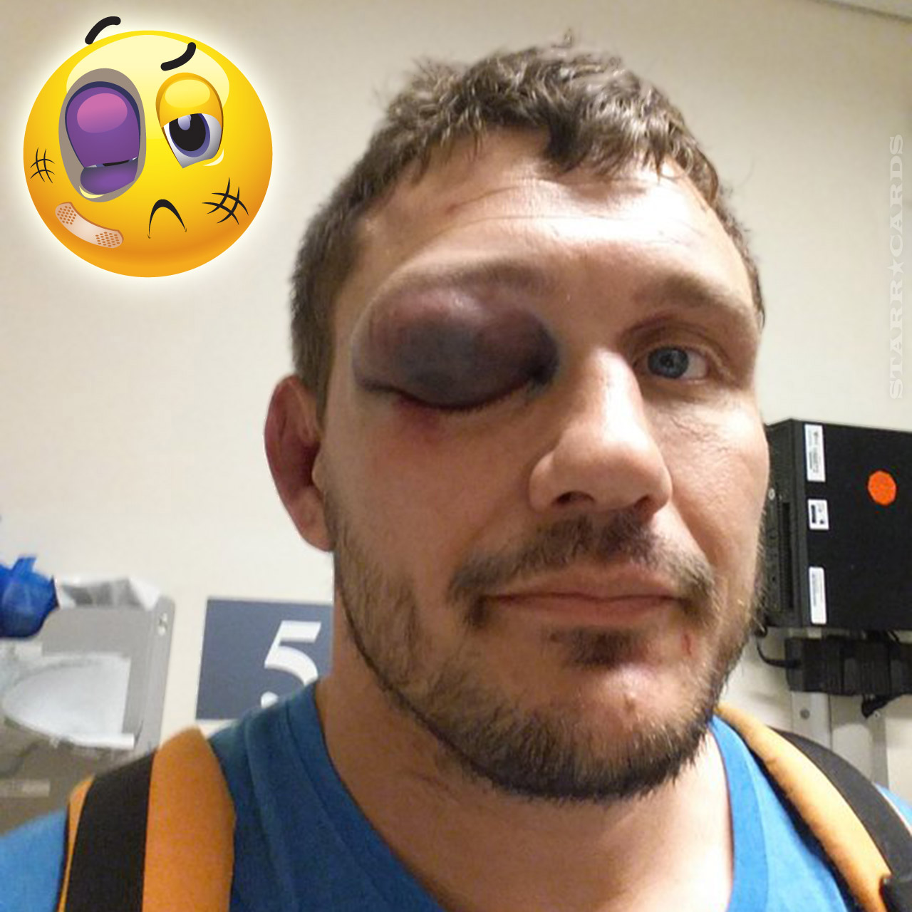 Matt Mitrione's eye swells up after fight with Travis Browne